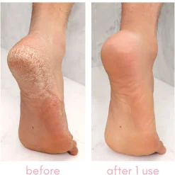 Heel-ing Callus Remover