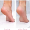 Heel-ing Callus Remover Kit