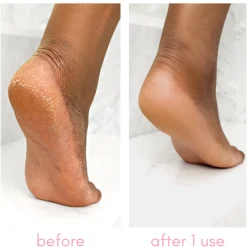 Heel-ing Callus Remover Kit