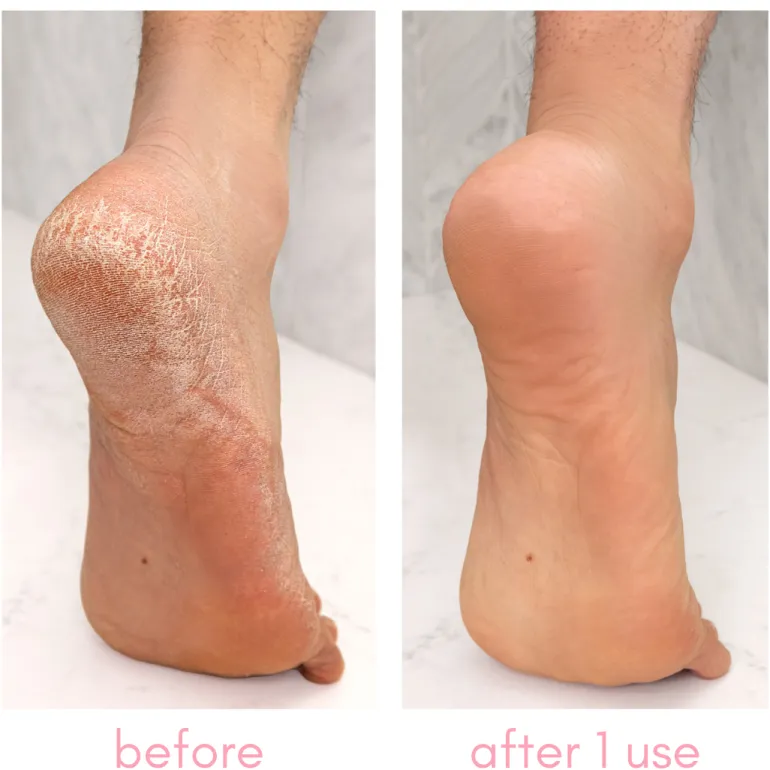 Heel-ing Callus Remover Kit